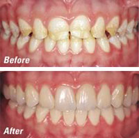 CEREC Crowns